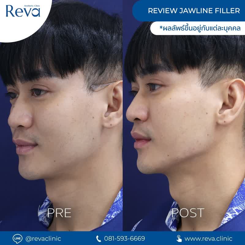 ผลลัพธ์ Re-FILLER