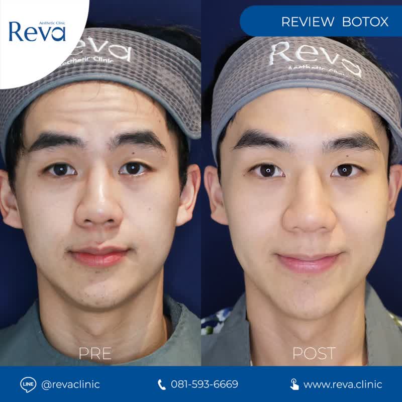 ผลลัพธ์ Reva BOTOX