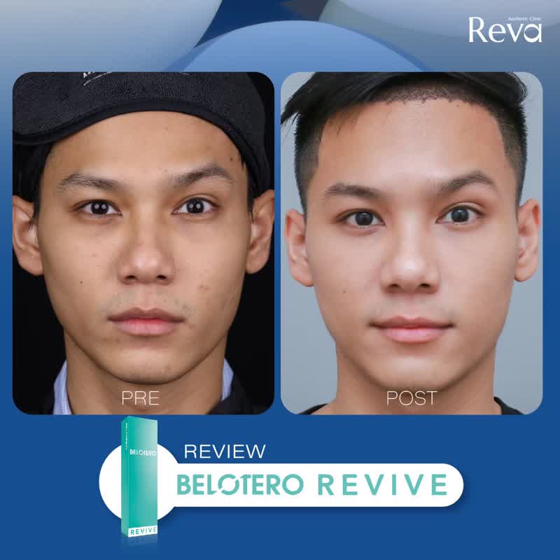 ผลลัพธ์ Belotero Revive