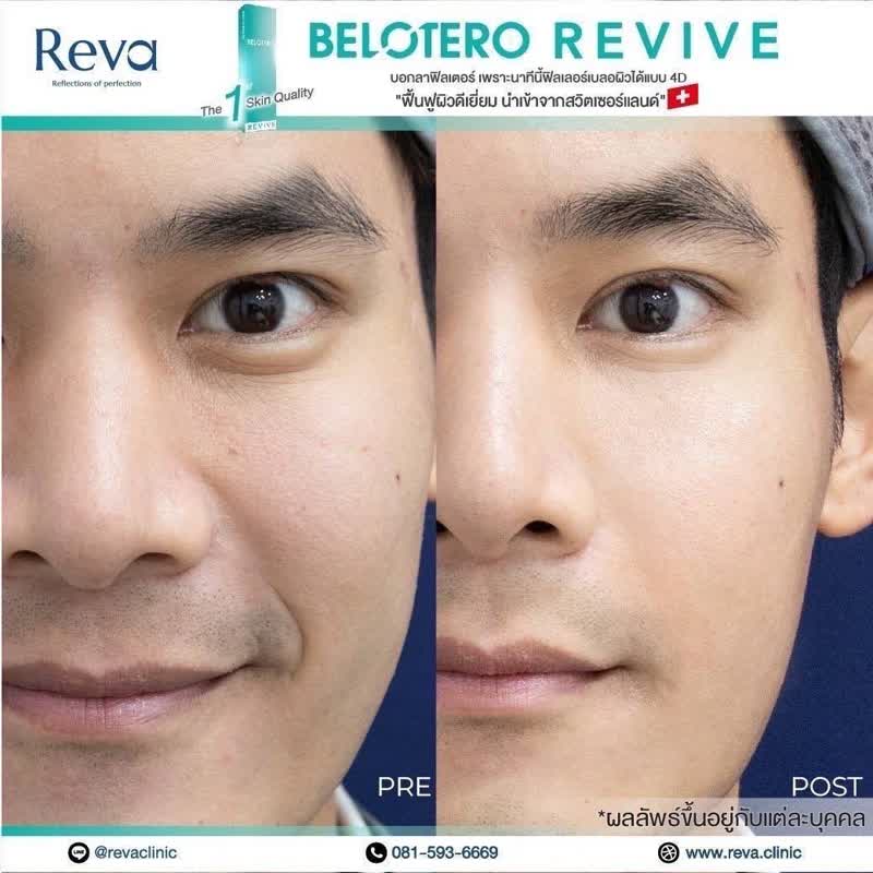 ผลลัพธ์ Belotero Revive